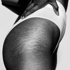 How to get rid of stretch marks