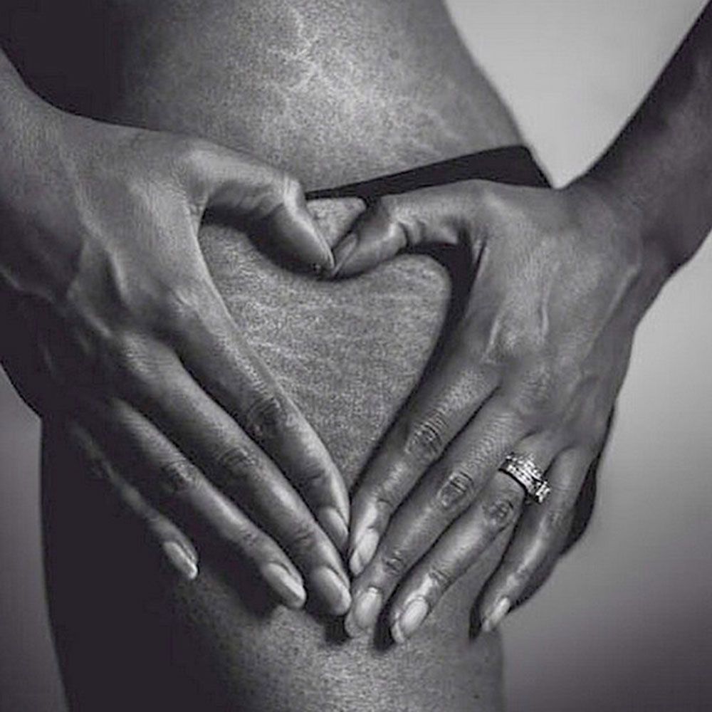 Stretch marks