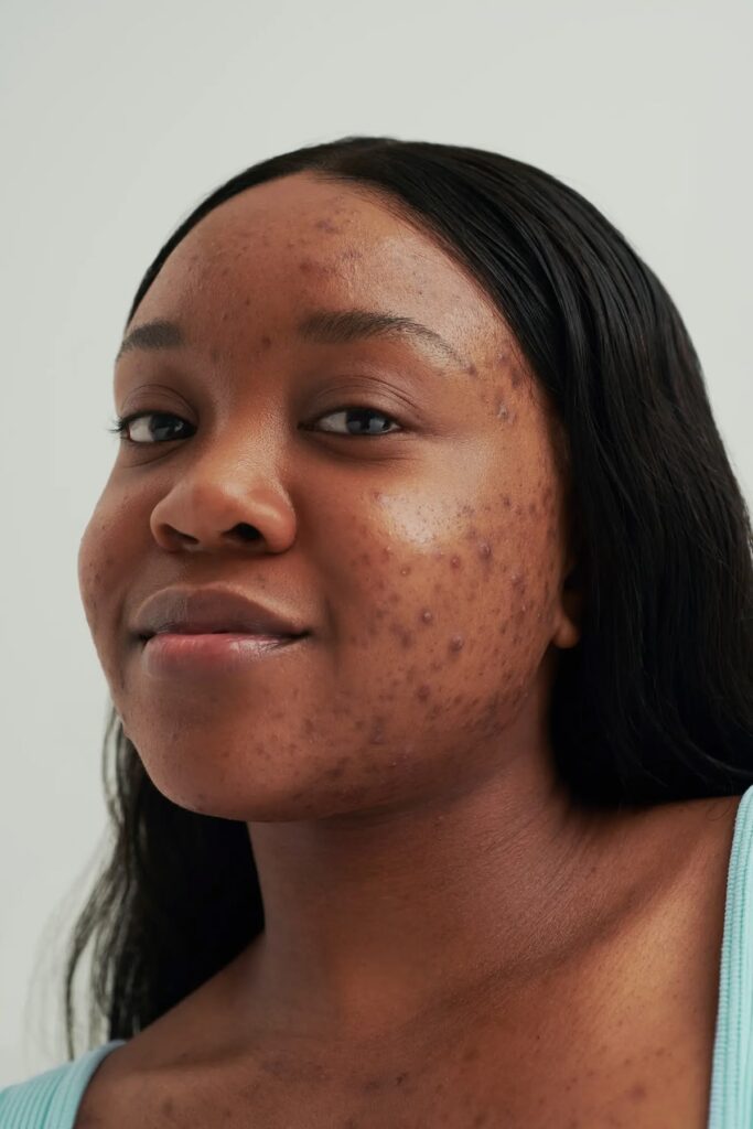hormonal acne